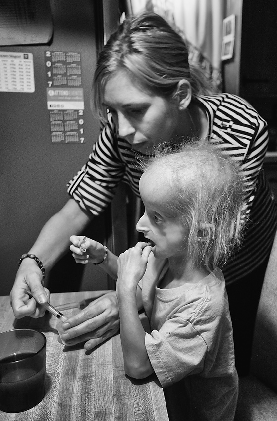 Award of Excellence, Feature Picture Story - Jeremy Wadsworth / The BladeCarly Kudzia, 7, who has progeria, relents and takes her experimental medication with the help of her mother Heather Unsinger at her home in Swanton, Ohio.